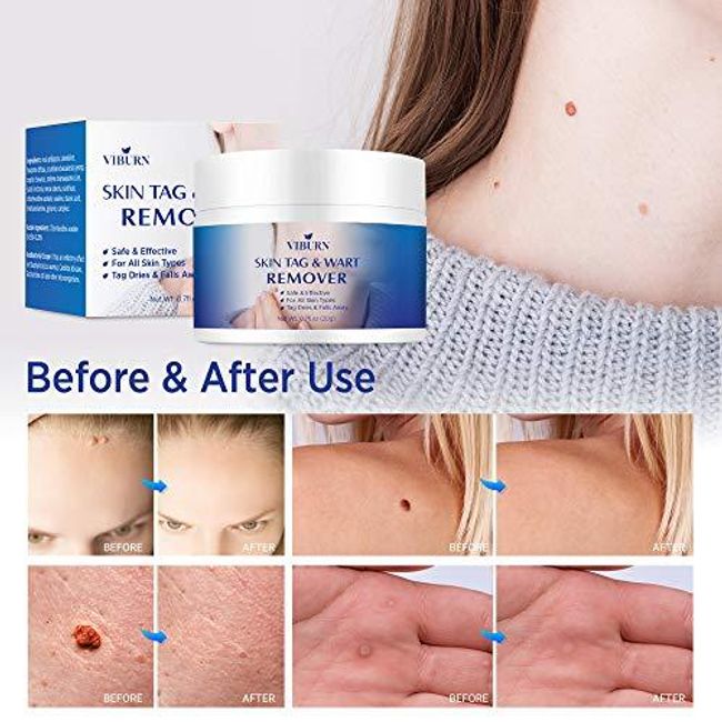 Skin Tag Remover, Warts & Mole Remover Cream